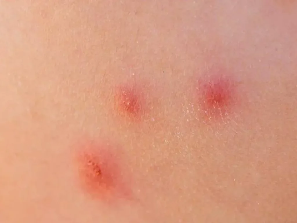 Morsure d'araignée