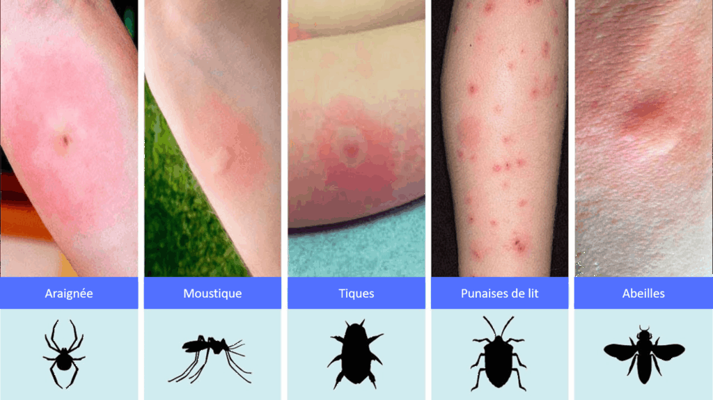 Comparaison entre piqûre de différents insectes dont : moustique, tique, punaise de lit, abeille, araignée